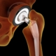 infezioni delle protesi ance ginocchio