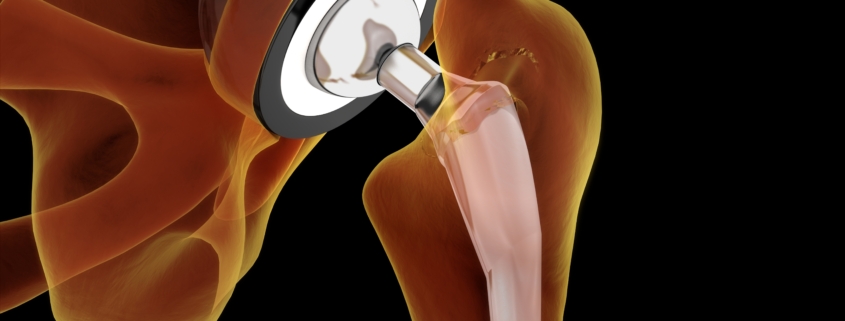 infezioni delle protesi ance ginocchio